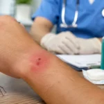 Types of Spider Bites Signs Risks and Treatment