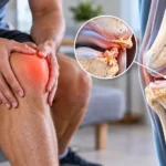 Bone Spurs in Knee Explained Meaning & Key Facts